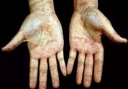 这个臭名昭著的性病，治好了仍会终生阳性？