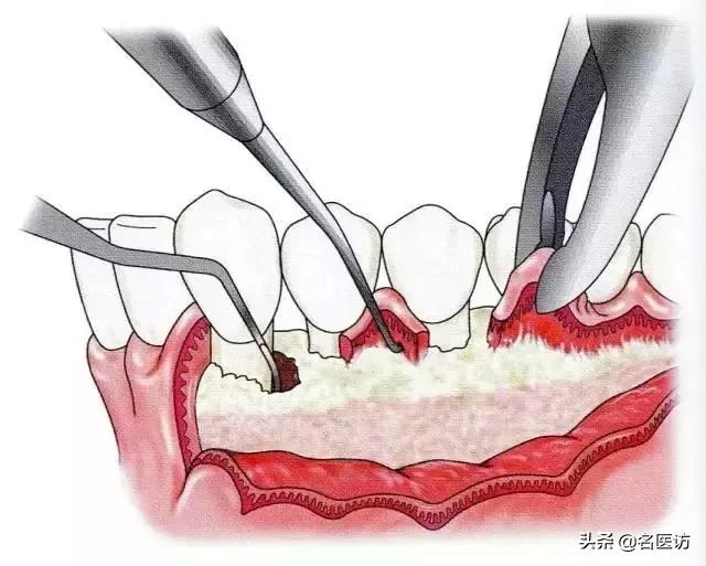 如果不小心得了牙周炎该怎么办,如果牙周炎不治疗会有什么后果