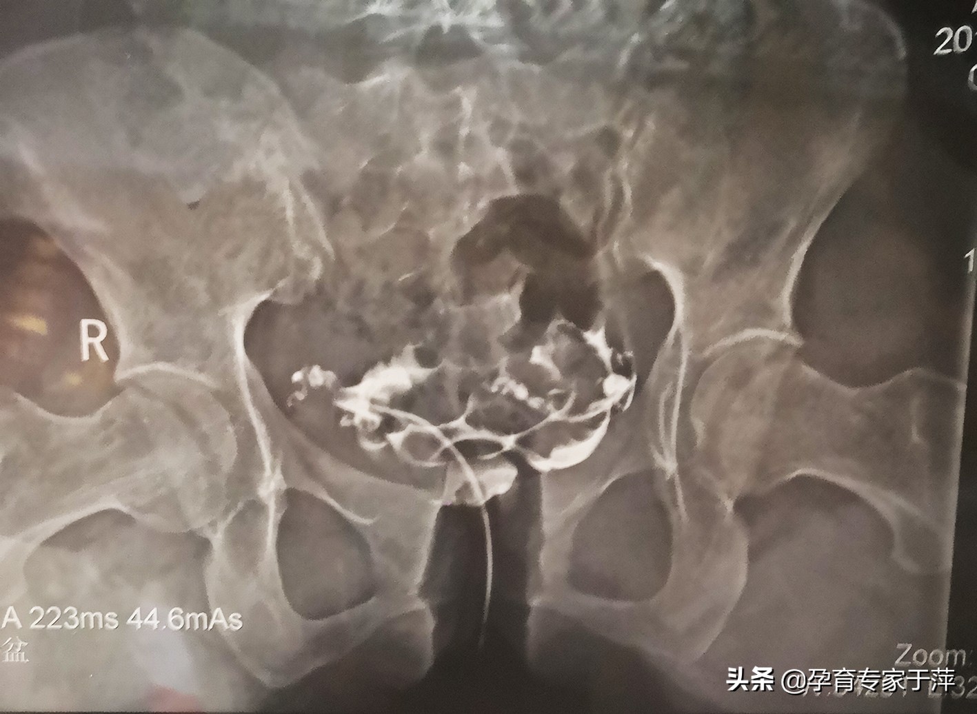 助孕专家于萍讲述,青岛专家于萍简介