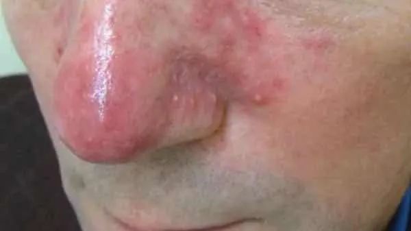 脸发红发烫小妙招有效改善红脸蛋,在暖气屋里脸发红发烫是怎么回事