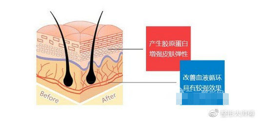 线雕面部提升是做什么的,面部线雕提升都做什么