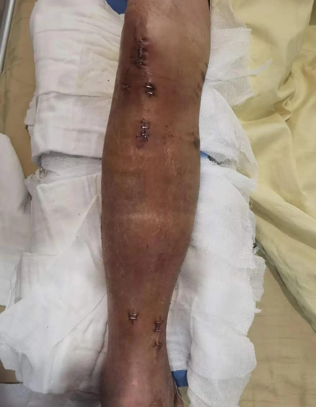 小腿骨断成三截了还能恢复吗,小腿断了三截能好彻底吗