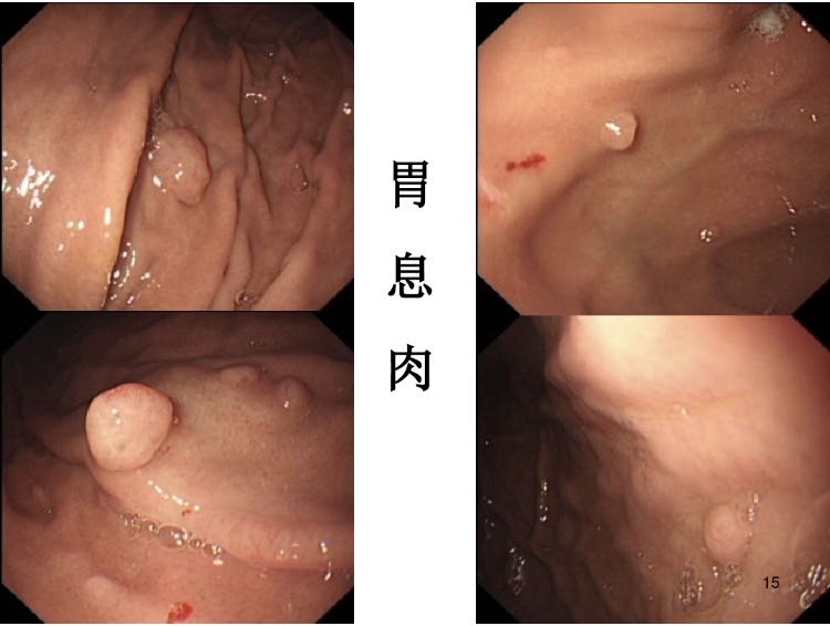 多发息肉和单发息肉哪个容易癌变,分叶息肉和带蒂息肉哪个容易癌变