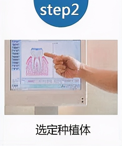 老人家种牙去哪里最好,50岁种牙最好方法怎么种