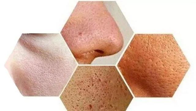 毛孔粗大如何改善最有效的方法,毛孔粗大目前最有效的方法