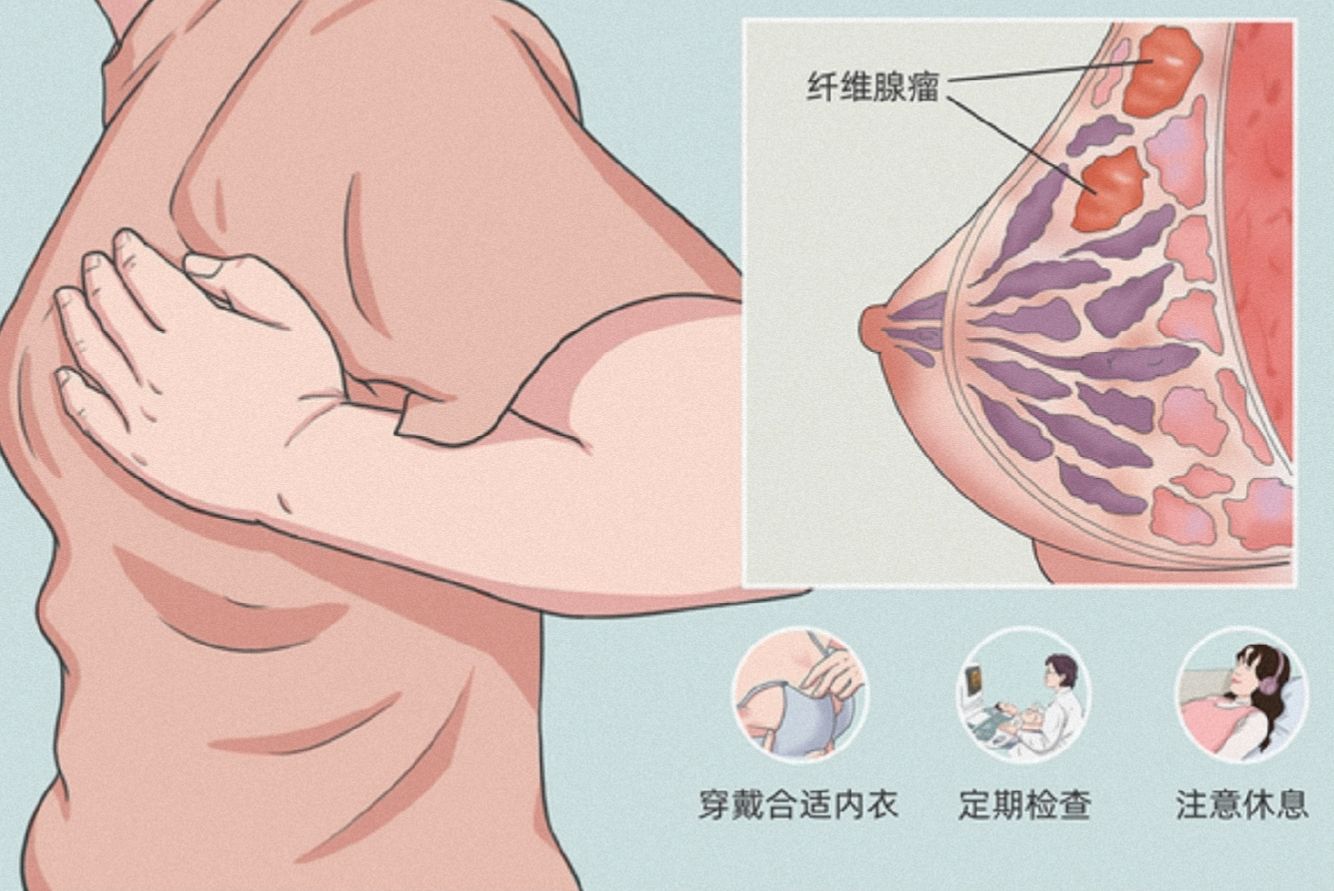 乳腺穿刺结果是纤维腺瘤,乳腺纤维腺瘤针灸有用吗