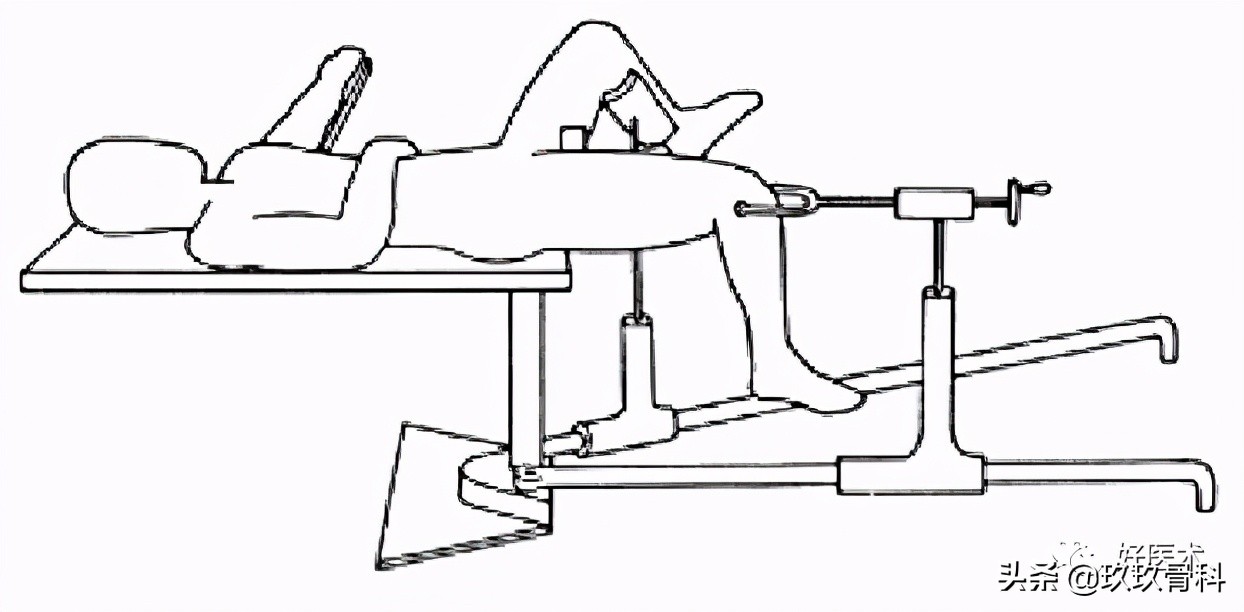 髓内钉技巧,髓内钉教学视频讲解