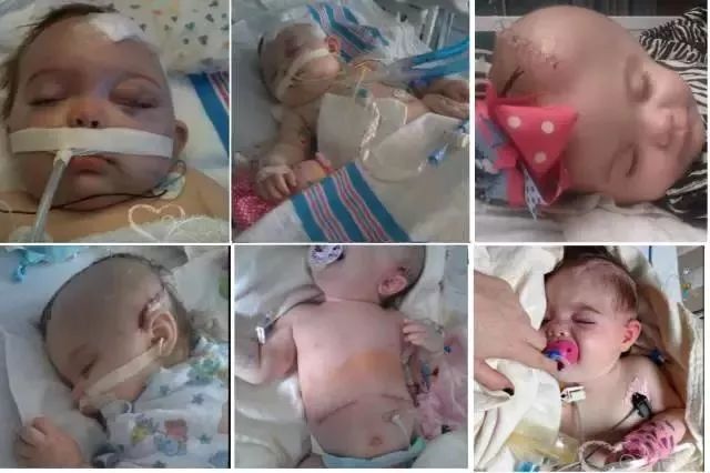 1岁宝宝偏瘫上肢康复训练,1岁孩子偏瘫康复视频