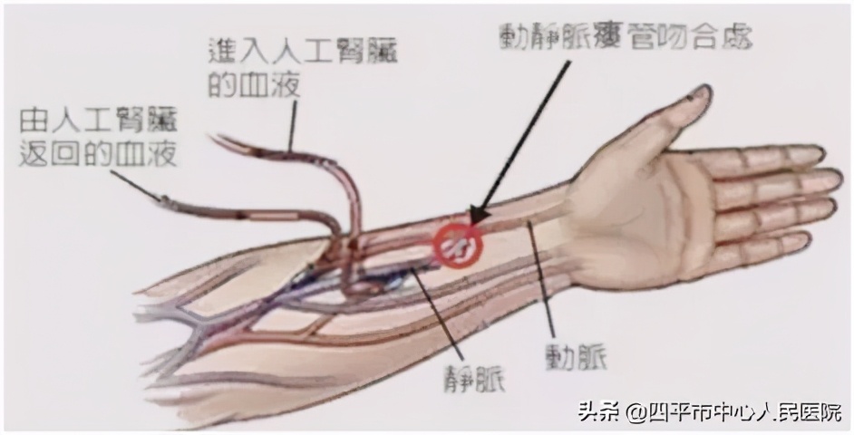 透析内瘘健康宣教小视频,透析患者内瘘护瘘宝有用吗
