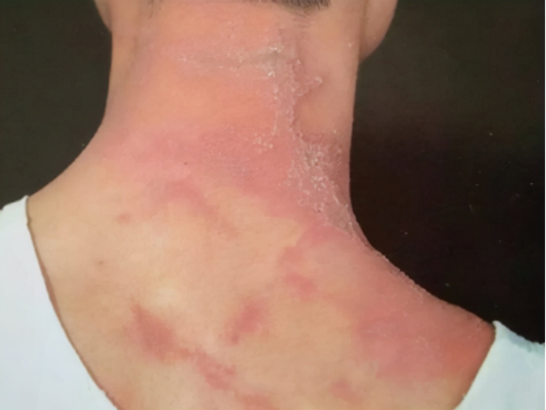 被隐翅虫毒液沾到涂什么药膏,被隐翅虫咬伤特效药