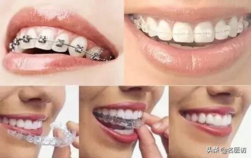 全隐形牙套矫正牙齿大概多少钱,隐形牙套咋改善脸型