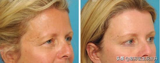 做完提眉术后如何才能不留疤痕,提眉术疤痕明显