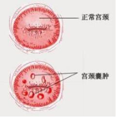 妇科医生：宫颈囊肿的症状有哪些？女性宫颈囊肿的危害有哪些？