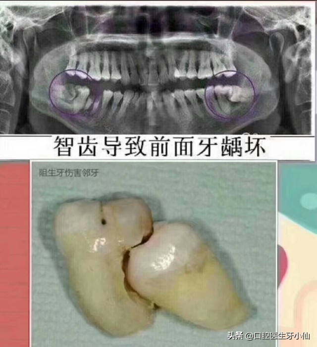 新冠期间智齿发炎肿痛怎么办,新冠期间智齿肿痛吃啥药