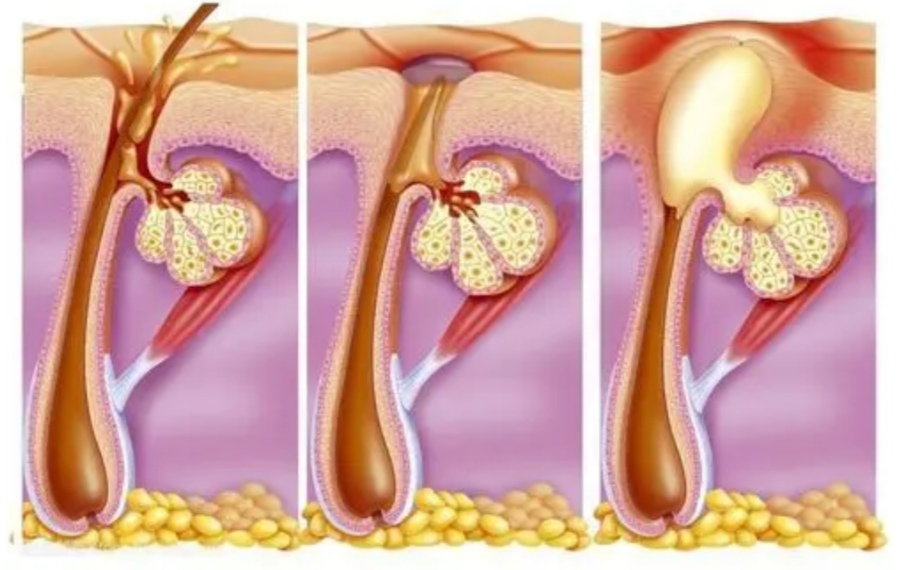 皮脂腺怎么处理,皮脂腺大怎么办