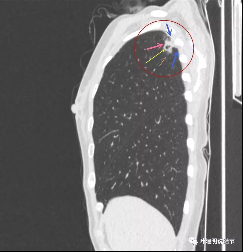 临床诊断孤立性肺结节,空洞型结节一般是什么性质