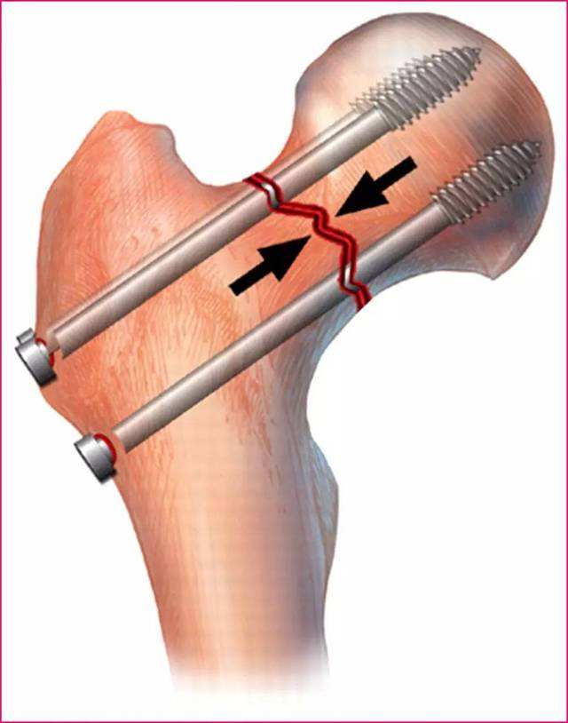 29岁右股骨颈骨折恢复最佳的方法,82老人股骨头摔骨折了该怎样治疗