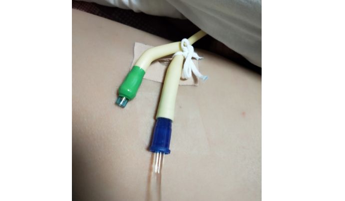 给患者插入导尿管,固定位置很重要