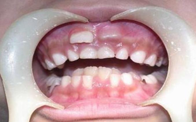 小朋友换牙歪歪扭扭,小孩换牙都长得歪歪扭扭怎么办