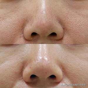 油性痘痘肌可以用白醋洗脸吗,白醋洗脸对脸毛孔有好处吗