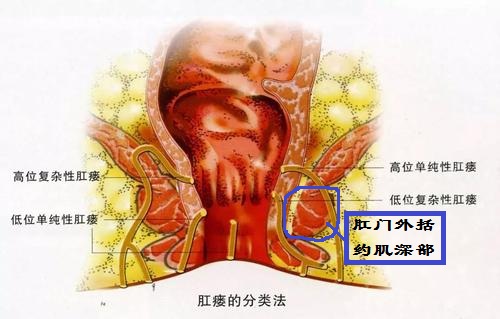 肛周脓肿有多少的几率变成肛瘘,肛周脓肿有多大的几率发展成肛瘘