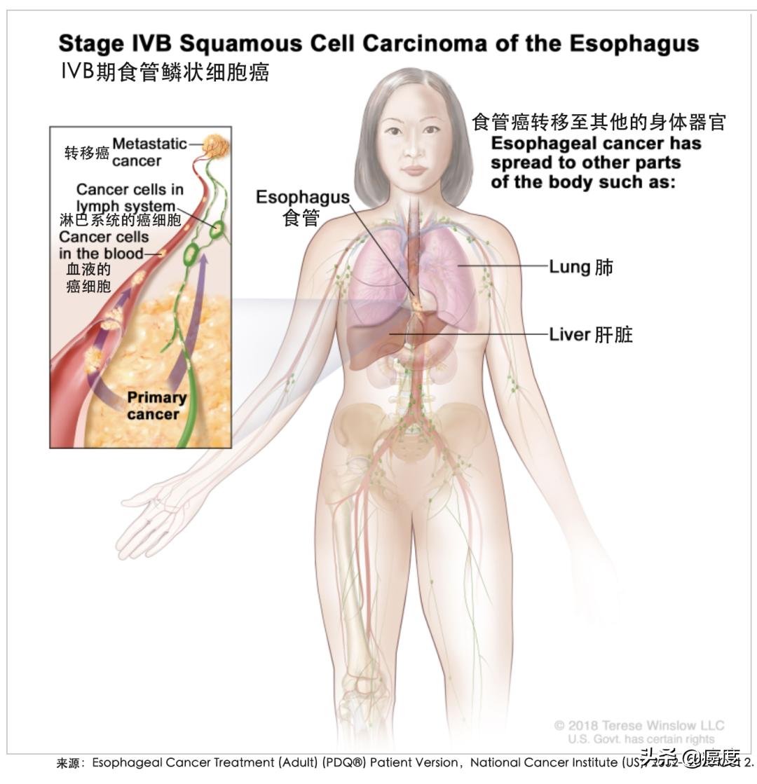 食管癌靶向治疗能治好吗,食管癌靶向治疗好还是免疫治疗好
