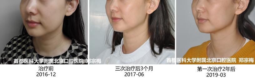 光子嫩肤基础护肤,基础护肤的光子嫩肤