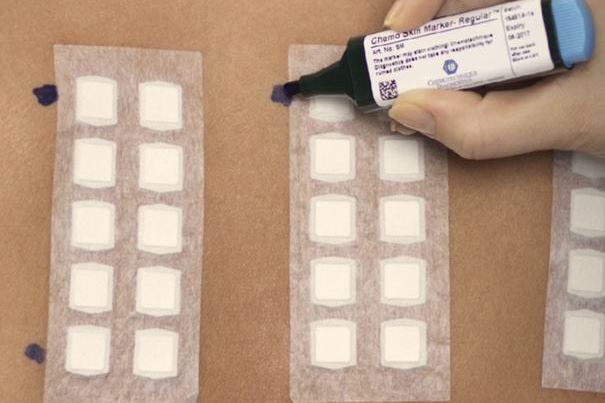 过敏性湿疹一年发作两次,湿疹反复查不到过敏源