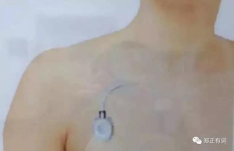 静脉输液港植入是治疗什么病的,静脉输液港植入术