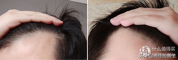 拯救发际线大作战,拯救发际线高男士