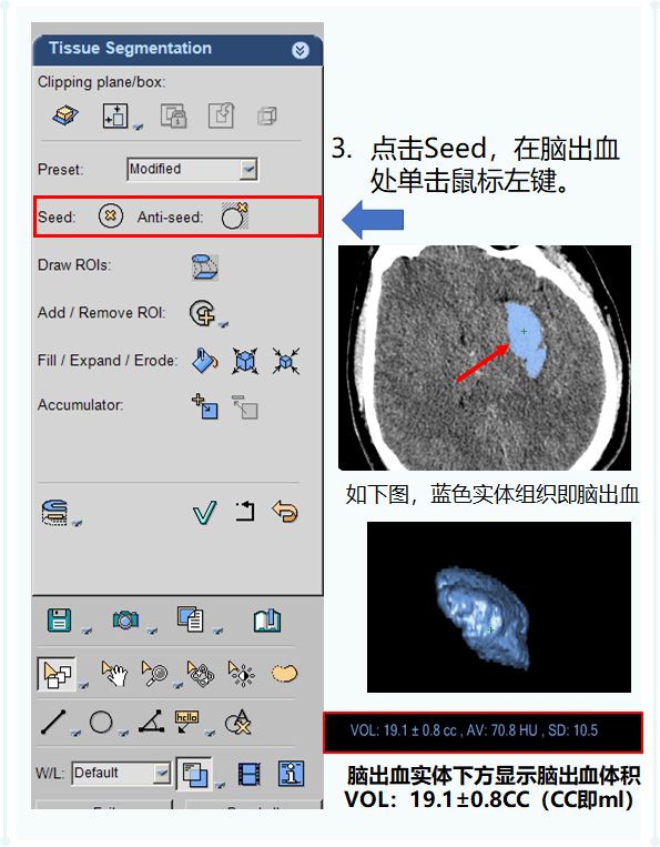 ct后处理重建技术,ct后处理技巧