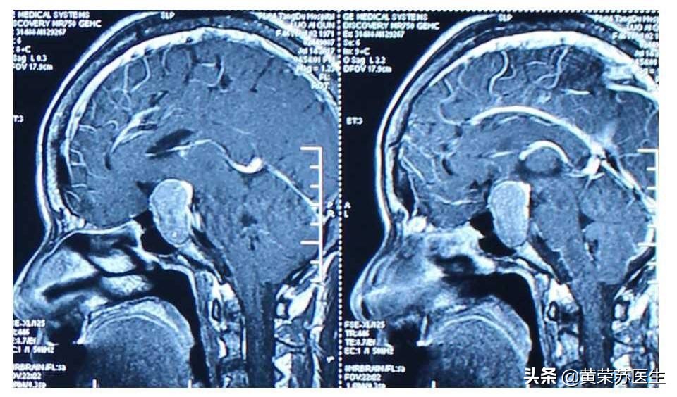 妊娠合并泌乳素瘤怎么办？
