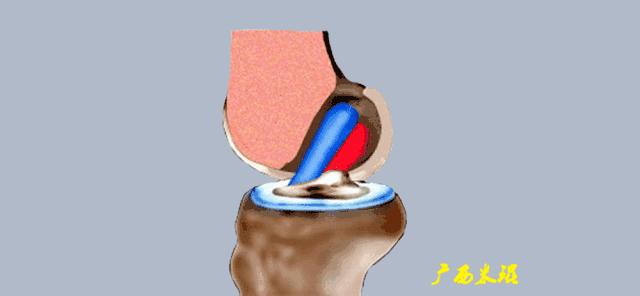 前交叉韧带扭伤最快自愈方法,前交叉韧带损伤膝关节会疼吗