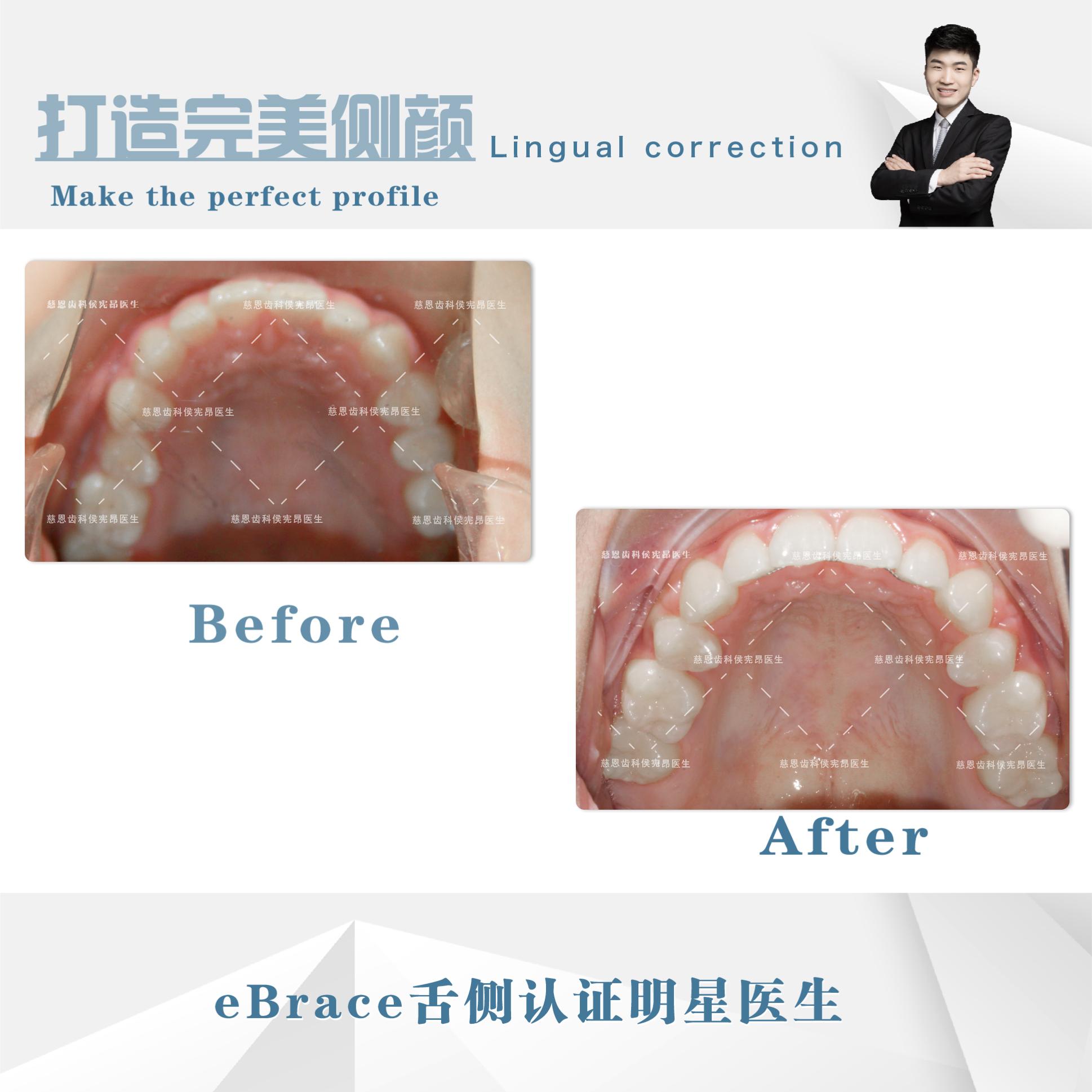 牙突怎么矫正,怎么矫正嘴突