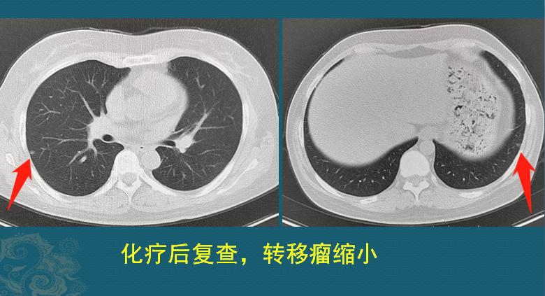 32岁女子抗癌19年相继患上5种癌,癌细胞转移最难治疗方法