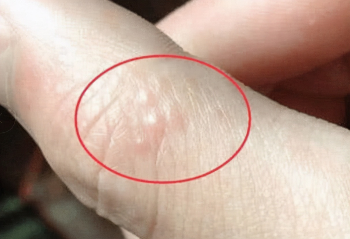 手上时不时起几个透明的小水泡,是大病的预兆吗?