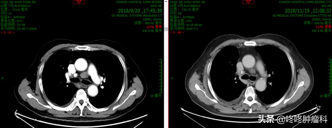 pd-1联合治疗治愈率,百济pd1的优势
