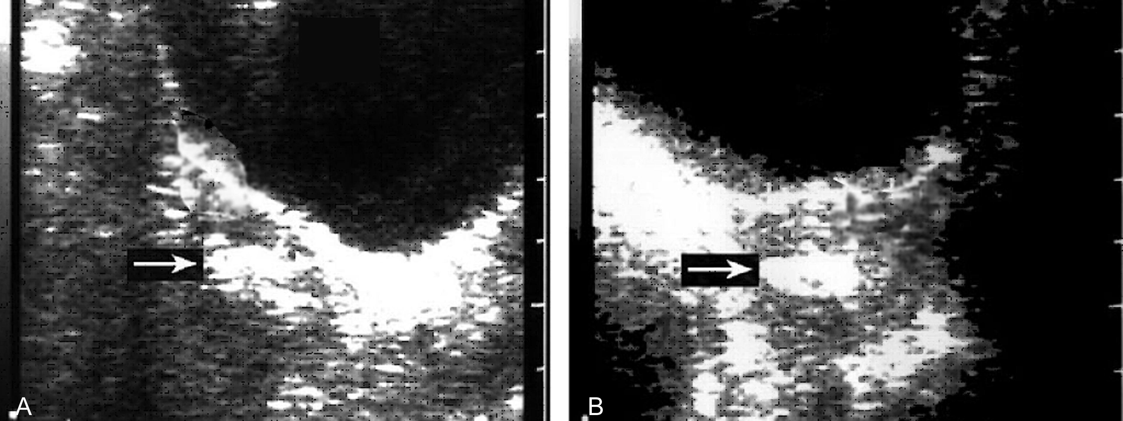 明明白白做超声32-3:流产:超声检查