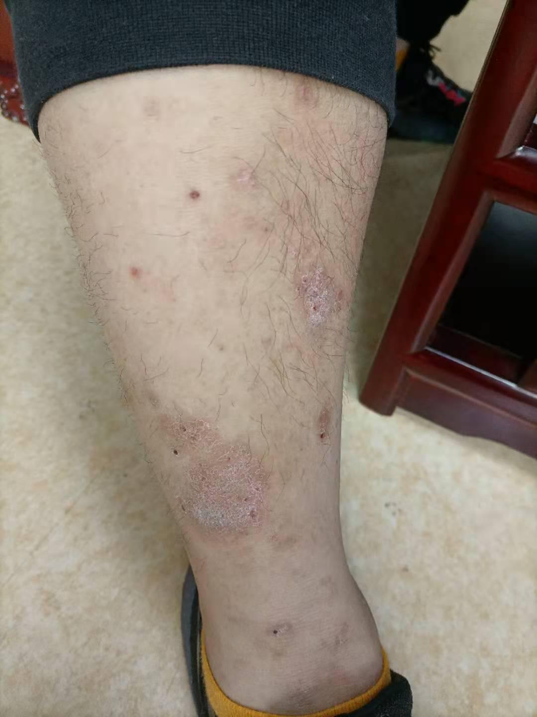 牛皮癣主要有哪几点认识误区,牛皮癣治疗别有弯路