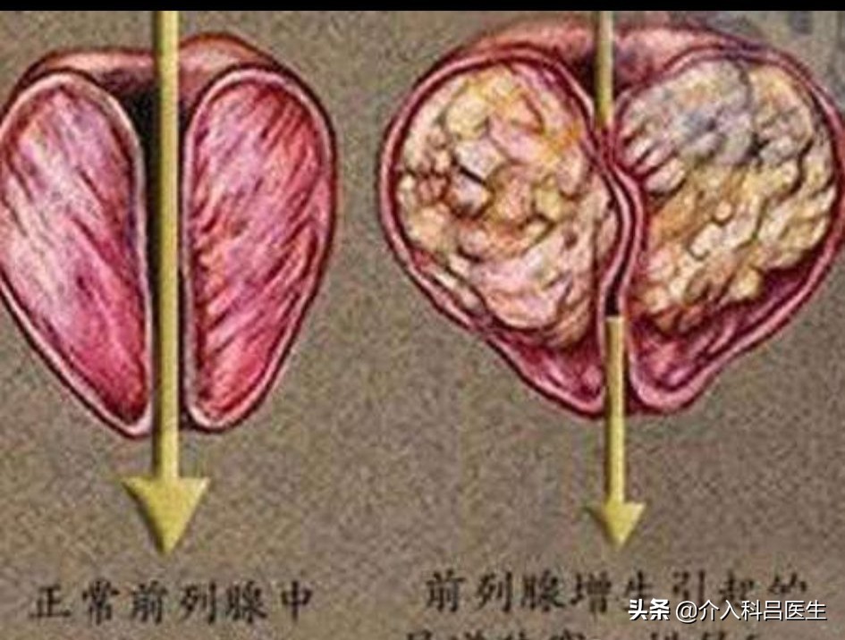 前列腺增生尿频夜尿多吃中成药,前列腺增生尿频尿急漏尿如何治疗