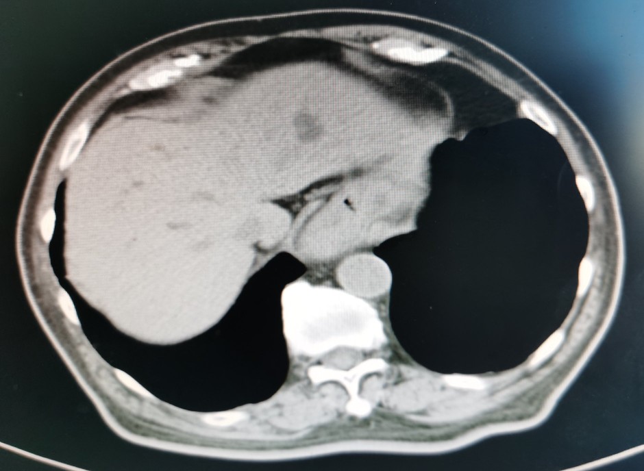 贲门癌吐血抢救,中国最著名的贲门癌治疗专家