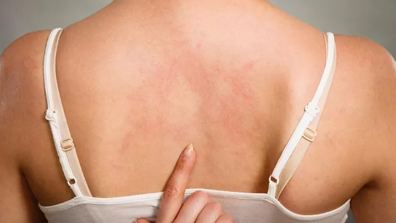 男生胸前背后长痘痘怎么治疗,胸前背后长痘痘流脓怎么解决