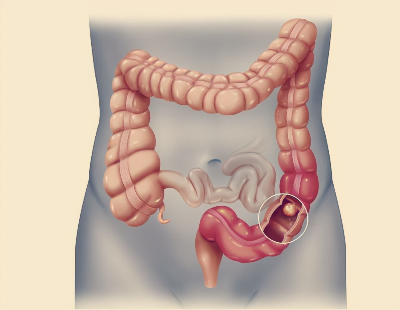 大肠癌科普知识结肠息肉知多少,大肠疾病分类及图片