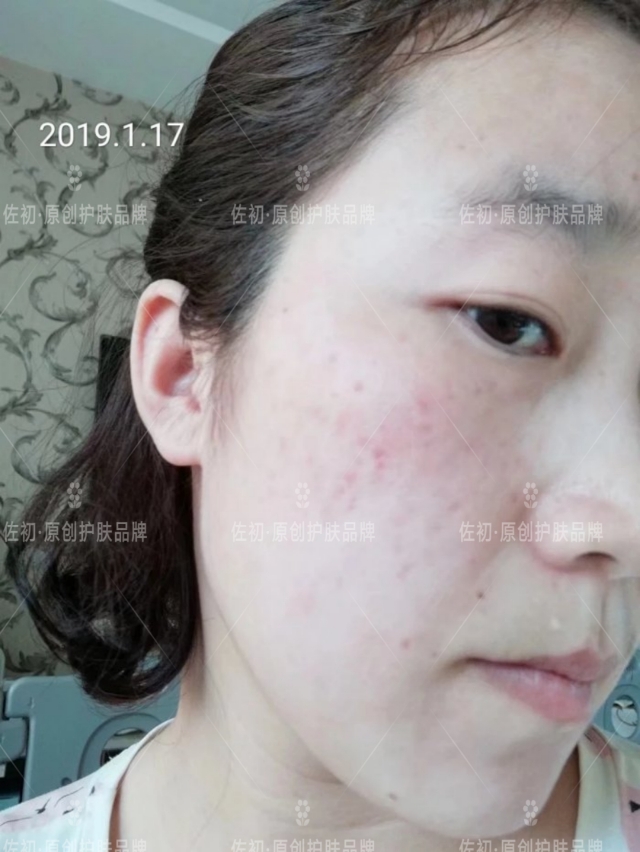 生完孩子烂脸,生完孩子脸上垮了怎样处理