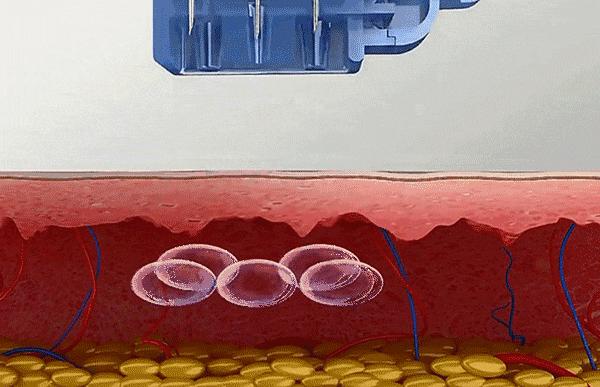 打水光针后的真实感受,水光针注射后1到7天的变化测评