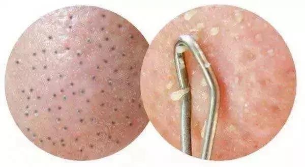 你知道黑头是怎么形成的吗,怎么分辨黑头的严重程度