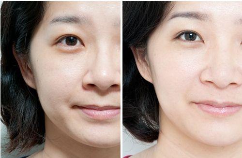 打玻尿酸和瘦脸针有什么后遗症,瘦脸针玻尿酸危害
