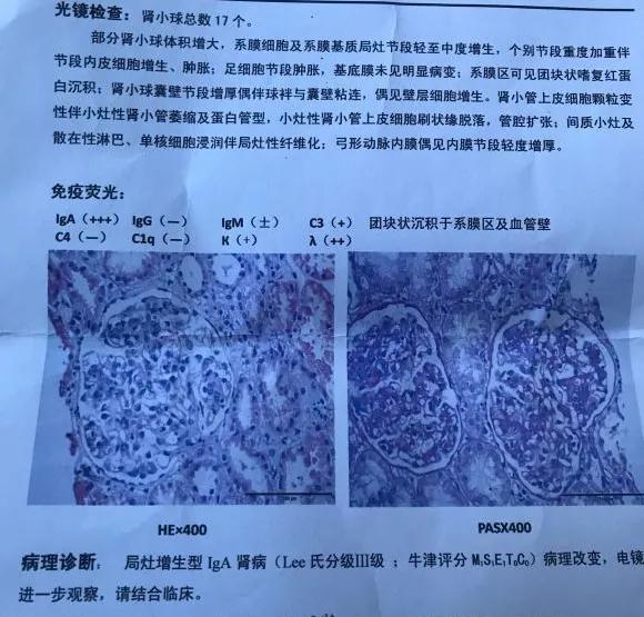 得了肾病综合征最好的治疗方法,得了肾病综合征吃哪些中成药