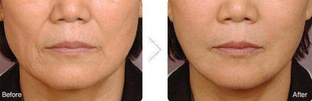 30多岁还能改善下巴后缩吗,30岁还能下颌后缩矫正吗