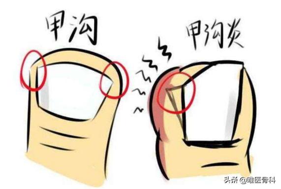 脚趾甲没扎到肉但是很痛怎么回事,脚指甲扎穿肉